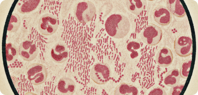 Difteria